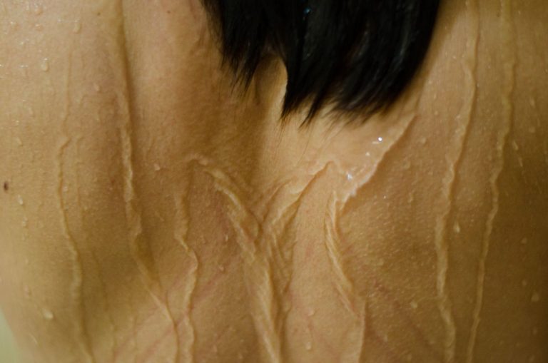 comment hydrater sa peau